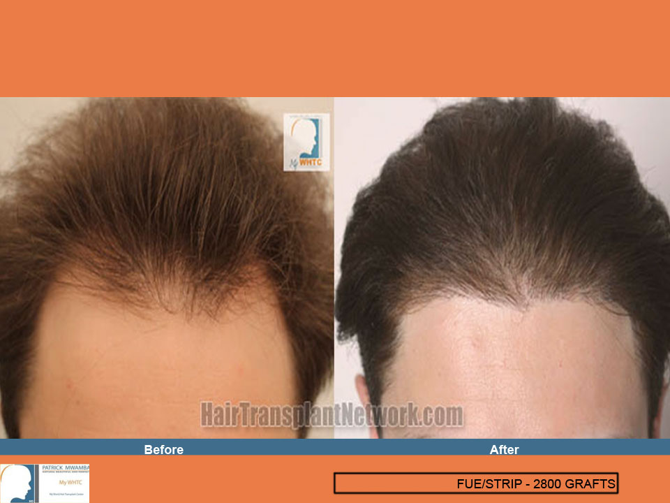 is finasteride better than minoxidil