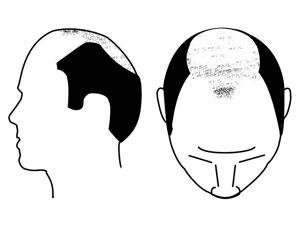 Hair loss image
